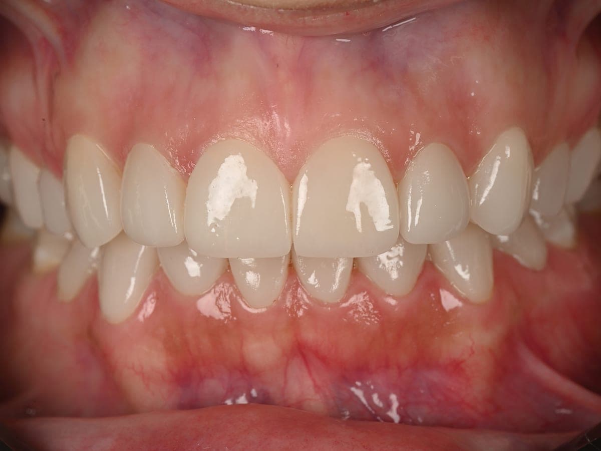 Dentición reconstruida tras rehabilitación oral en AS Odontología Digital