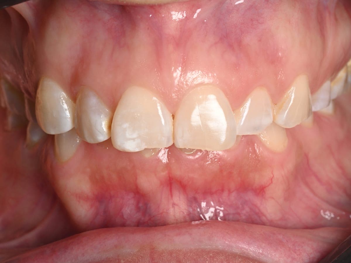Dentición con erosión severa antes del tratamiento en AS Odontología Digital